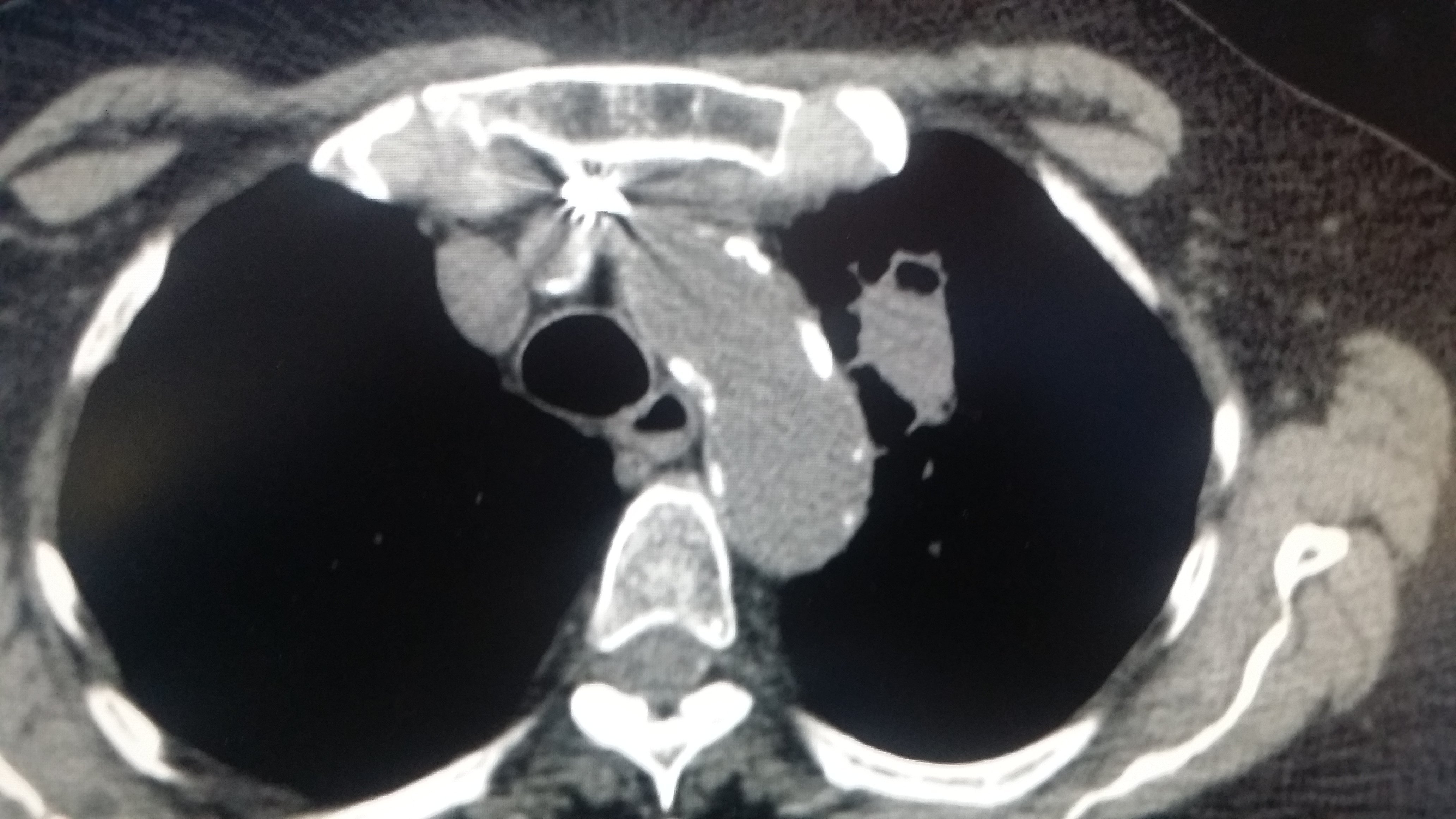 Small-Cell Lung Cancer