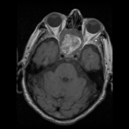 Sinonasal adenocarcinoma | Radiology Reference Article | Radiopaedia.org