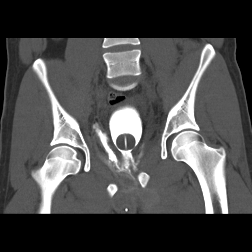 Pelvic fractures with urethral rupture | Image | Radiopaedia.org