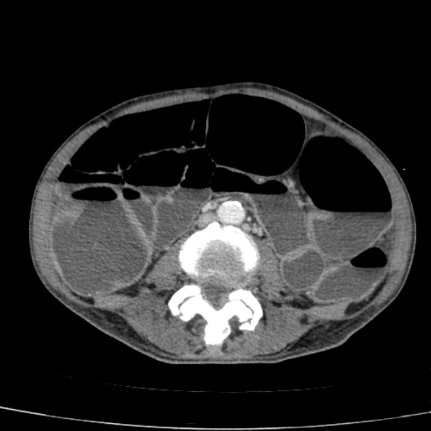 Paralytic Ileus