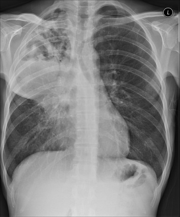 Lung abscess | Radiology Reference Article | Radiopaedia.org