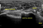 Ultrasound of the shoulder | Radiology Reference Article | Radiopaedia.org