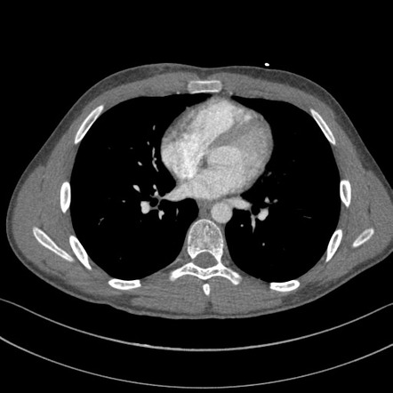 Patent ductus arteriosus | Radiology Case | Radiopaedia.org