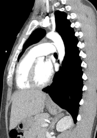 Patent ductus arteriosus | Radiology Reference Article | Radiopaedia.org