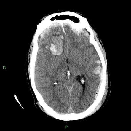 Traumatic brain injury | Radiology Reference Article | Radiopaedia.org