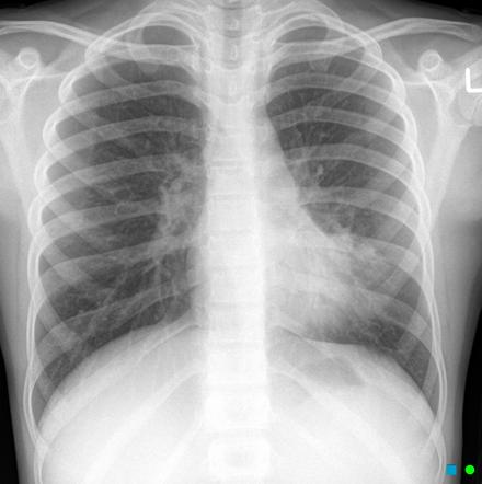 Consolidation | Radiology Reference Article | Radiopaedia.org