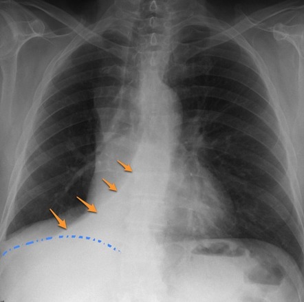 Right lower lobe collapse | Radiology Reference Article | Radiopaedia.org