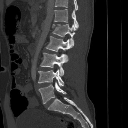 Types Of Spinal Fractures