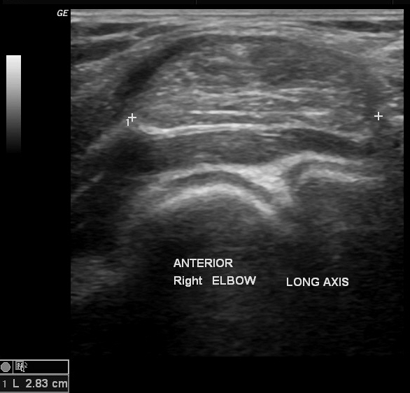 Elbow lipoma | Image | Radiopaedia.org