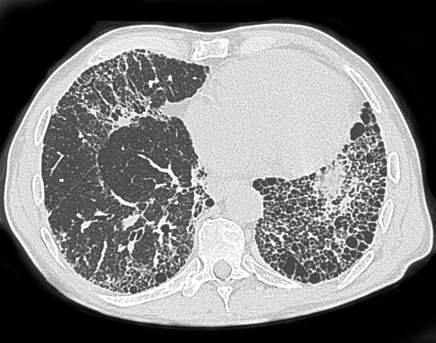 Idiopathic Pulmonary Fibrosis Honeycomb