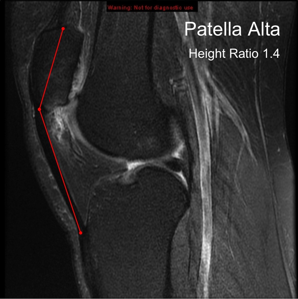 Patella Alta With Hoffa S Fat Pad Impingement Image Radiopaedia Org ...