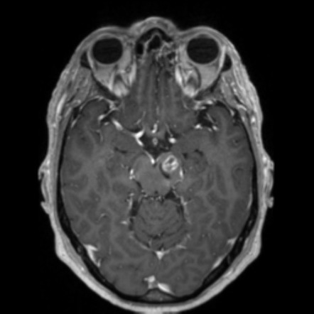 Oligoastrocytoma NOS with pseudoprogression | Radiology Case ...