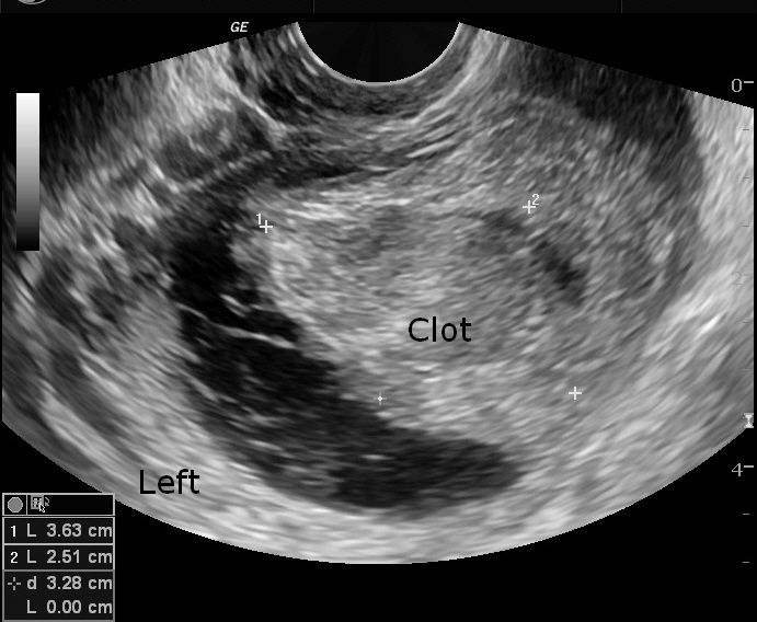 Ruptured corpus luteal cyst | Image | Radiopaedia.org