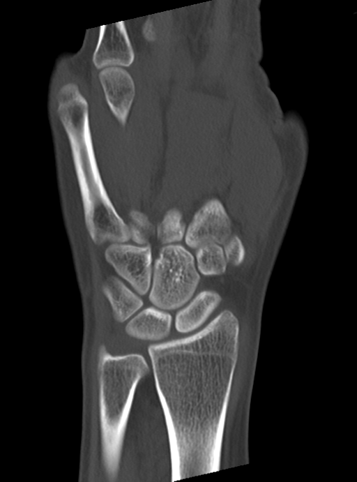 Normal wrist CT | Image | Radiopaedia.org