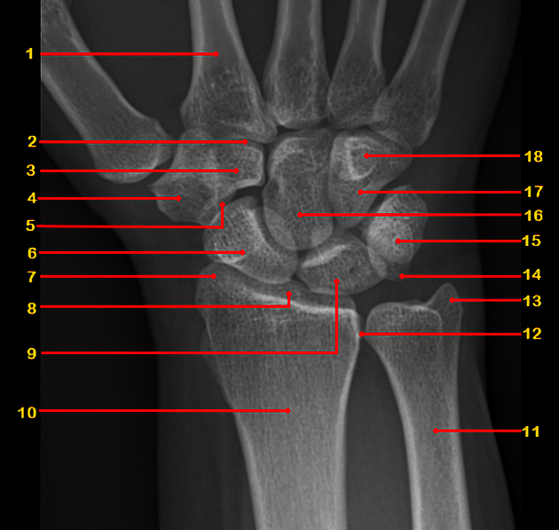 Wrist Joint X Ray