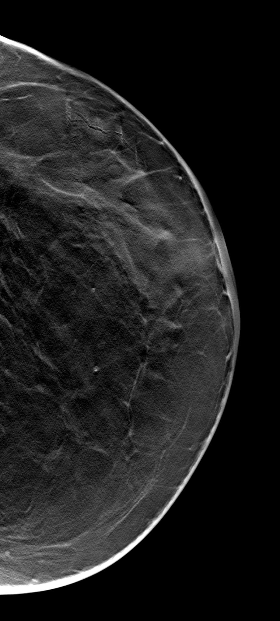 Malignant breast calcification | Image | Radiopaedia.org