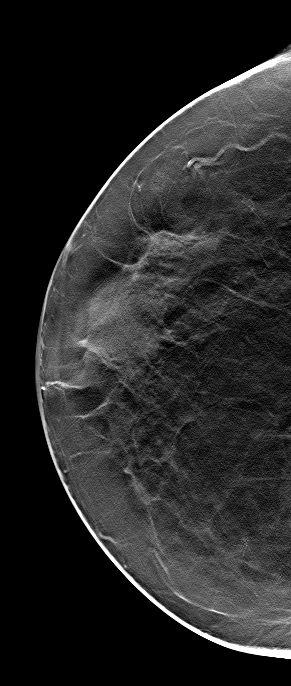 Malignant breast calcification | Image | Radiopaedia.org