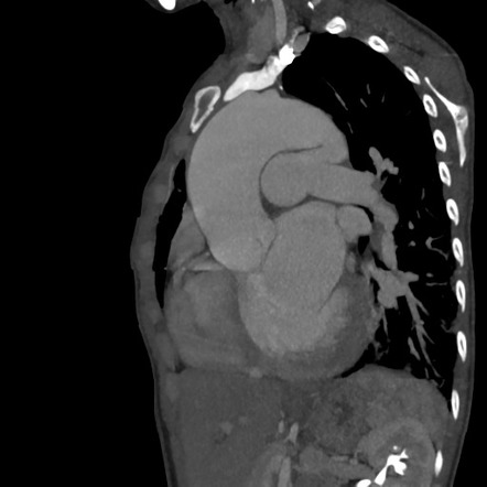 Patent ductus arteriosus | Radiology Reference Article | Radiopaedia.org