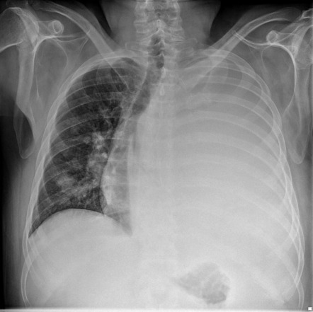 Hemithorax white-out (differential) | Radiology Reference Article ...