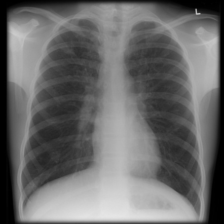 Pulmonary Fibrosis X Ray