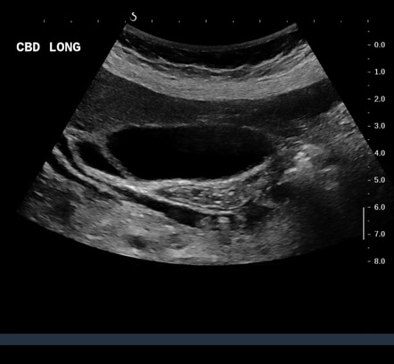 Choledocholithiasis | Image | Radiopaedia.org