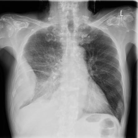 Empyema | Radiology Reference Article | Radiopaedia.org