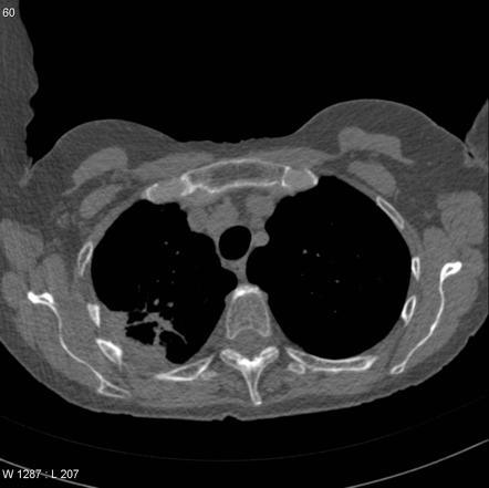 Large cell lung cancer | Radiology Reference Article | Radiopaedia.org