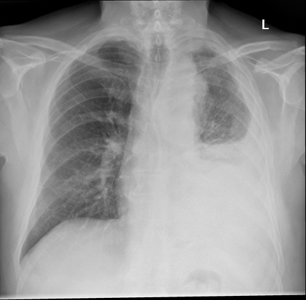 Pleural tumor and effusion | Radiology Case | Radiopaedia.org