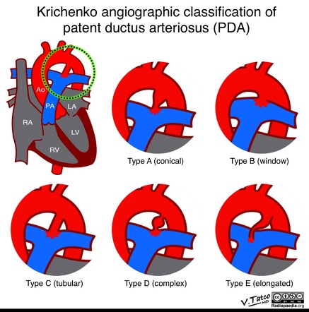 Patent ductus arteriosus | Radiology Reference Article | Radiopaedia.org