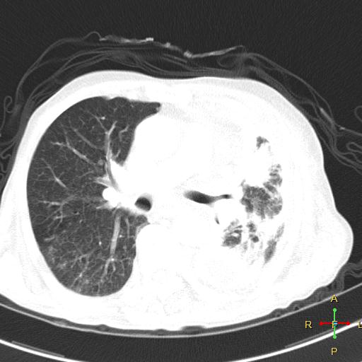 Epithelioid mesothelioma | Image | Radiopaedia.org