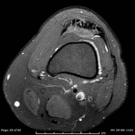 Quadriceps fat pad impingement syndrome | Image | Radiopaedia.org