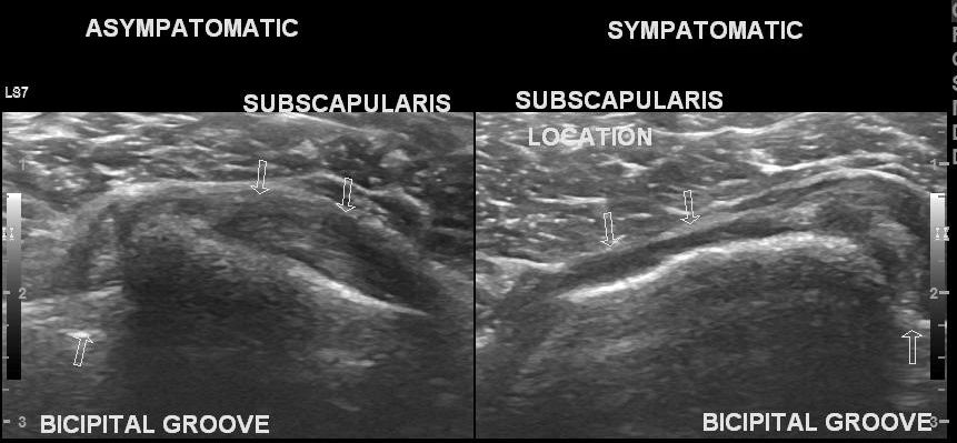 Subscapularis tendon tear | Image | Radiopaedia.org