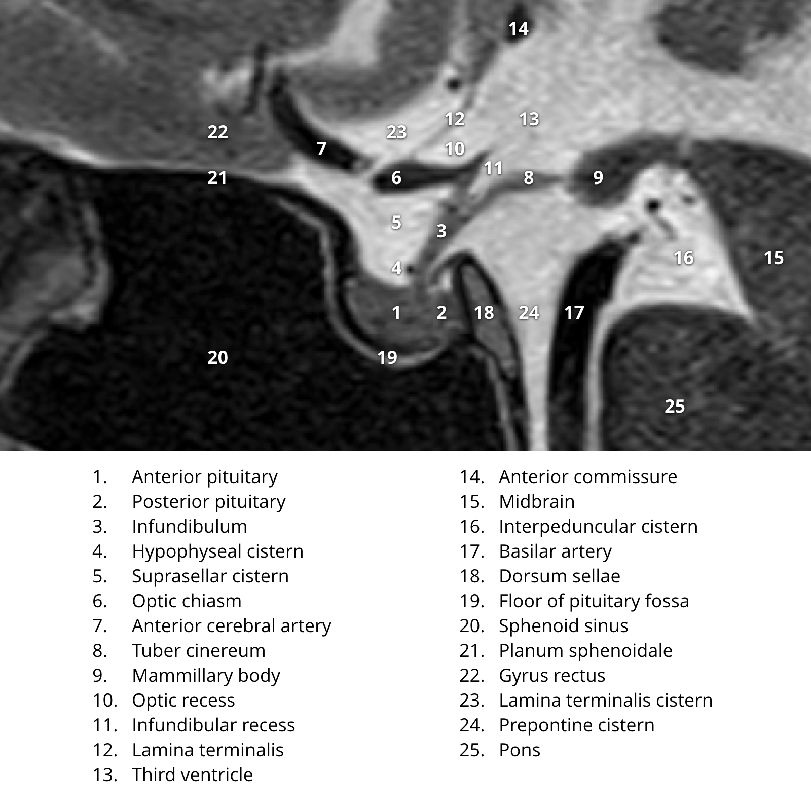 Normal pituitary MRI (sagittal T2 only) | Image | Radiopaedia.org