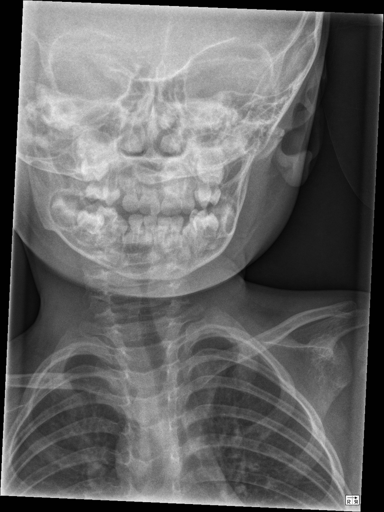 Normal Epiglottis X Ray