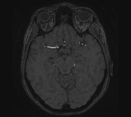 Accessory middle cerebral artery | Radiology Reference Article ...