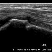 Osteochondroma | Radiology Reference Article | Radiopaedia.org