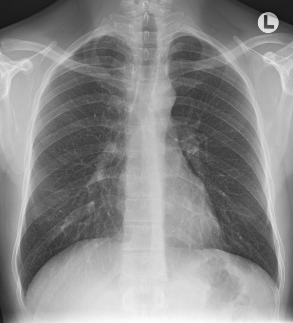 Image: Chest X-Ray Of A Patient With Pericardial Effusion, 44% OFF