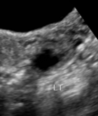 Pelvic Inflammatory Disease Ultrasound