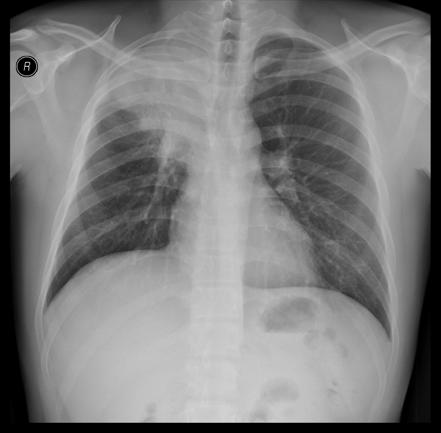 Post primary tuberculosis | Radiology Case | Radiopaedia.org