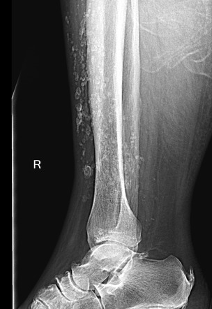 Soft tissue calcifications due to chronic venous insufficiency | Image