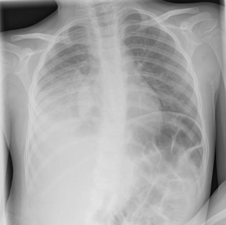 Consolidation | Radiology Reference Article | Radiopaedia.org