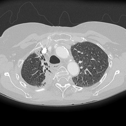 Radiation Fibrosis Lung