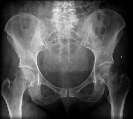 Subcapital Femoral Neck Fracture