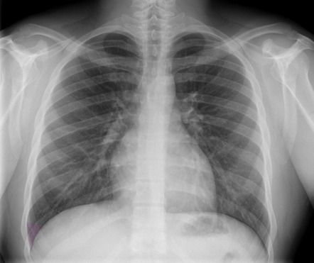 Chest X Ray Consolidation Vs Infiltrate