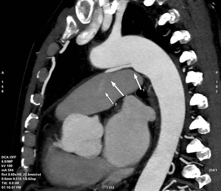 Patent ductus arteriosus | Radiology Reference Article | Radiopaedia.org