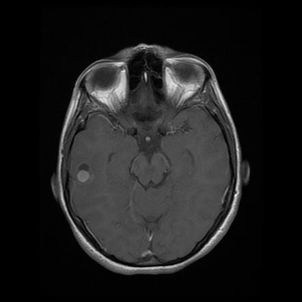 Pleomorphic xanthoastrocytoma | Image | Radiopaedia.org