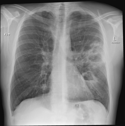 Playlist 'Mamdouh Mahfouz - Chest (focal lung lesions)' by Dr Mohamed ...