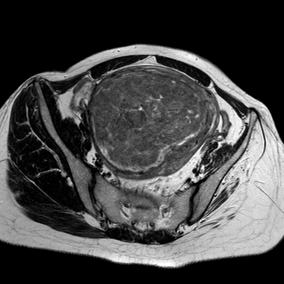 Huge subserosal uterine leiomyoma (fibroid) | Image | Radiopaedia.org