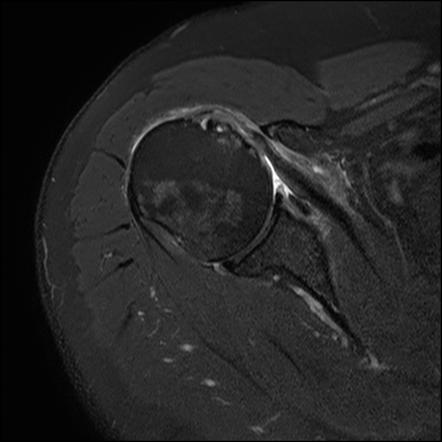 Subscapularis tendon tear | Radiology Reference Article | Radiopaedia.org