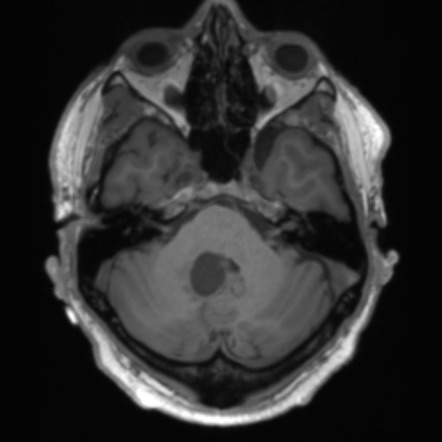 Hemangioblastoma | Radiology Case | Radiopaedia.org